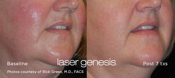 Laser Genesis behandeling van het gelaat