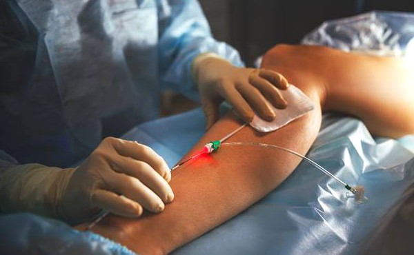 Endoveneuze laserbehandeling