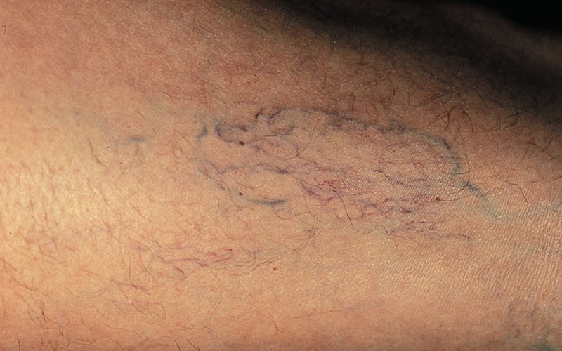 Voor de behandeling met sclerotherapie