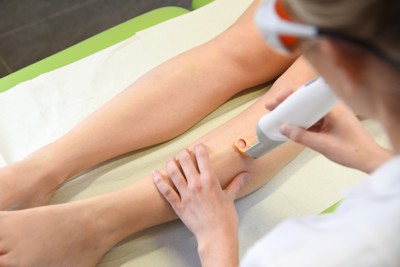 Behandeling van kleine adertjes op de benen met een vaatlaser